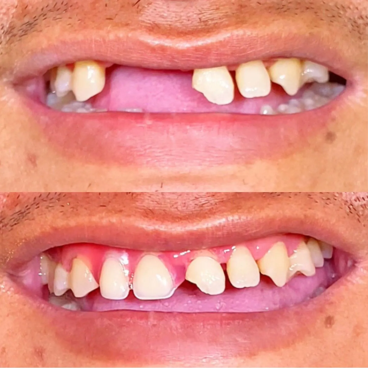 Gigi Tiruan Valplast (Fleksibel)