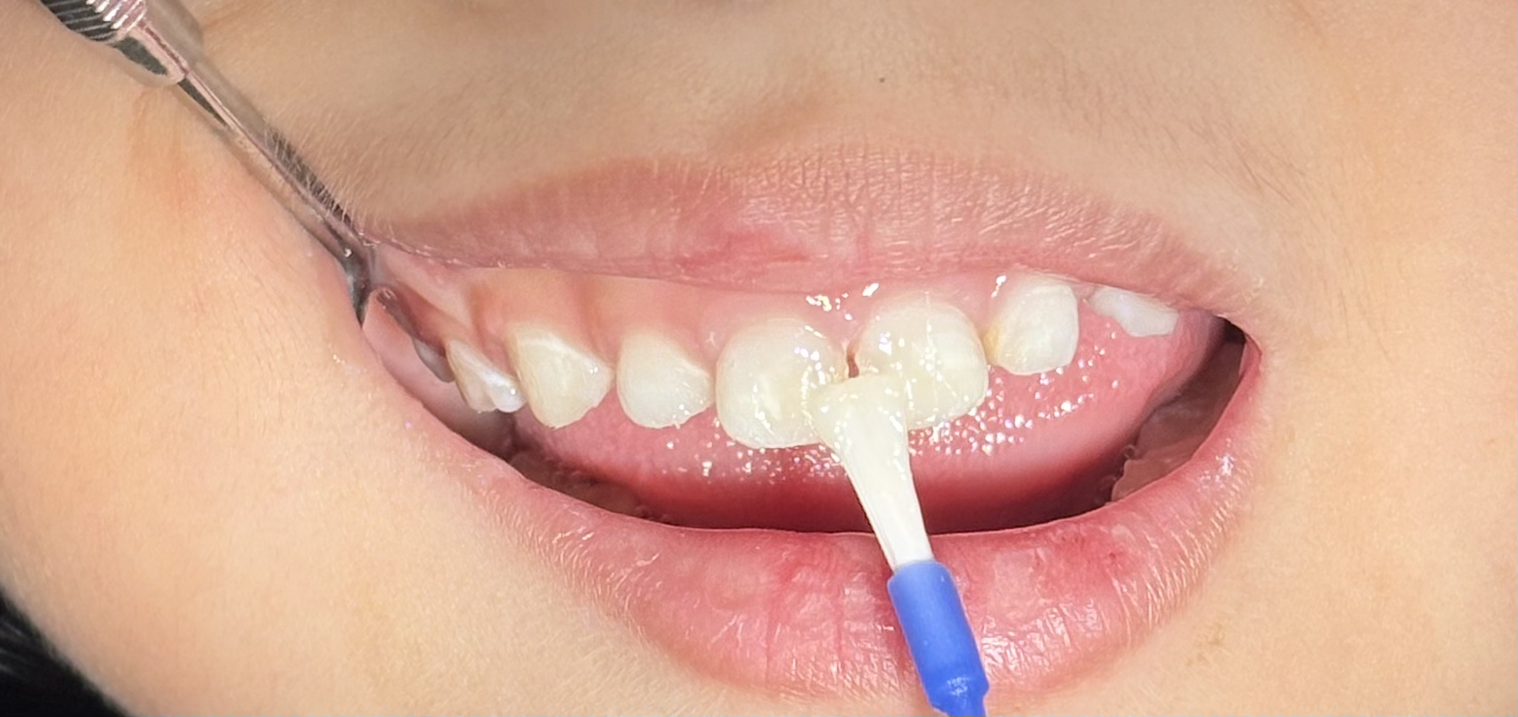 Topikal Aplikasi Fluoride